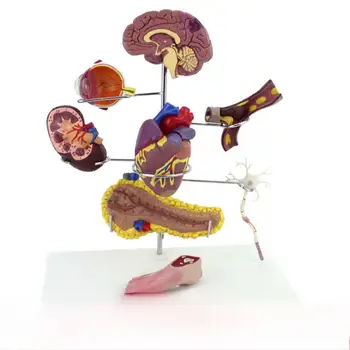 Миниатюрная модель инсульта мозга при диабете человека Медицинская школа